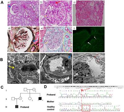 A mouse model for X-linked Alport syndrome induced by Del-ATGG in the Col4a5 gene